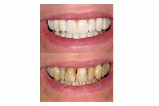 Denture Cleaning & Adhesive Remover Fizzing Magic Powder– Stain Removal, Adhesive Remover, Sanitizer & Breath Freshener