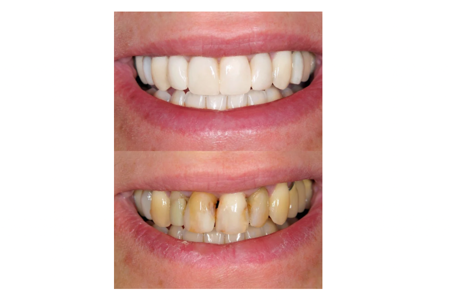 Dental Genie: Dental Bleach Trays Professional Kit