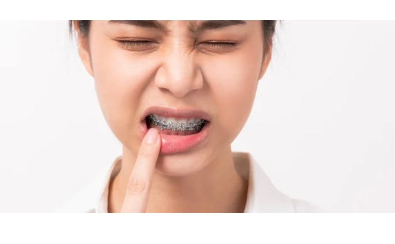 Dental Genie: 2 Pack-Braces Wax Stick- w/ Healing Tallow & Beeswax